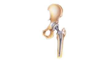 Hip Replacement drug lawsuits